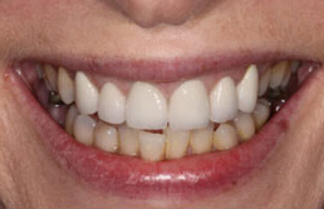 After (Teeth)