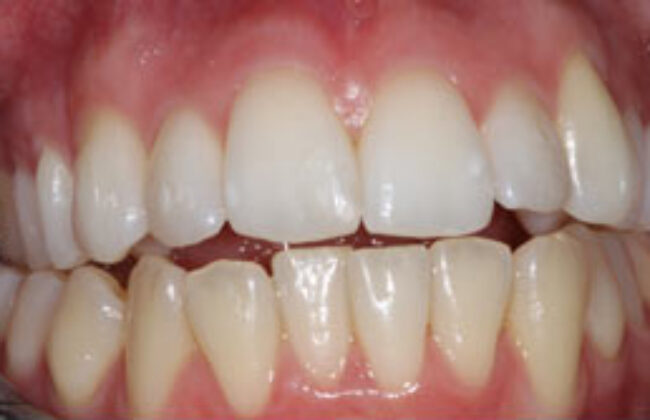 After (Teeth)