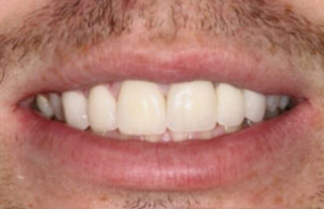 After (Teeth)