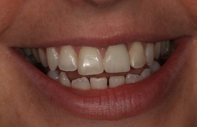 After (Teeth)