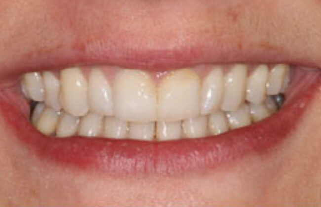 After (Teeth)