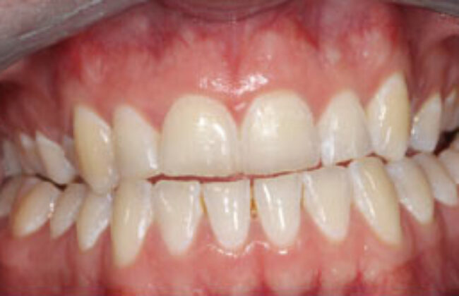 After (Teeth)
