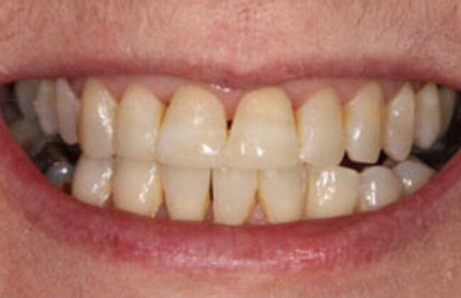 After (Teeth)