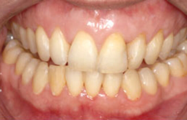 After (Teeth)
