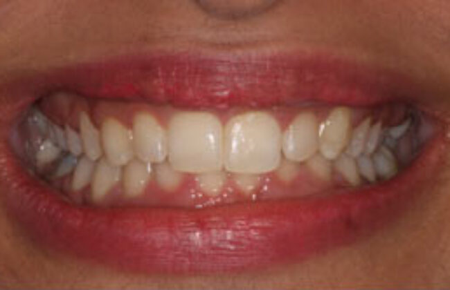 After (Teeth)