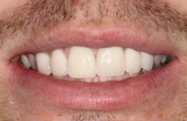 After (Teeth)