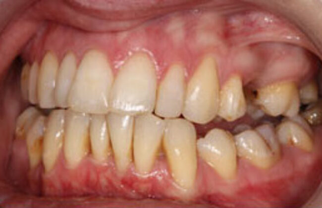 After (Teeth)