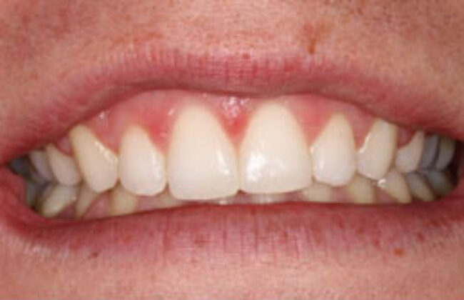 After (Teeth)