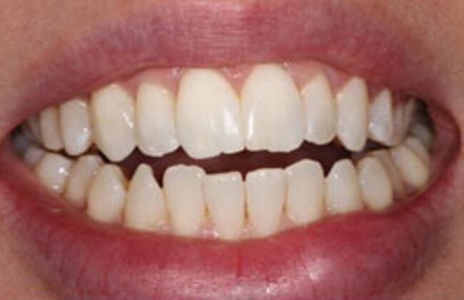 After (Teeth)