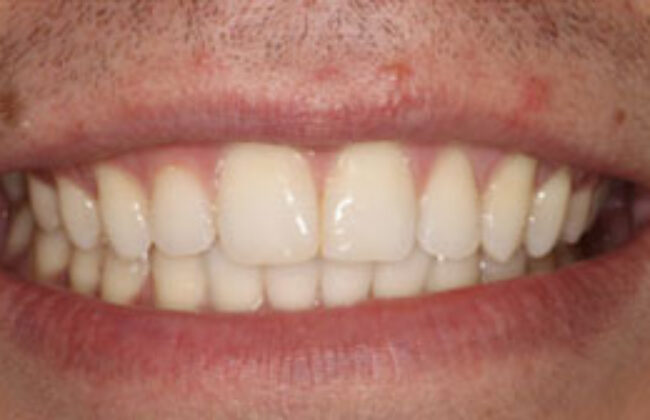 After (Teeth)