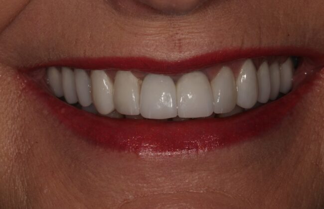 After (Teeth)