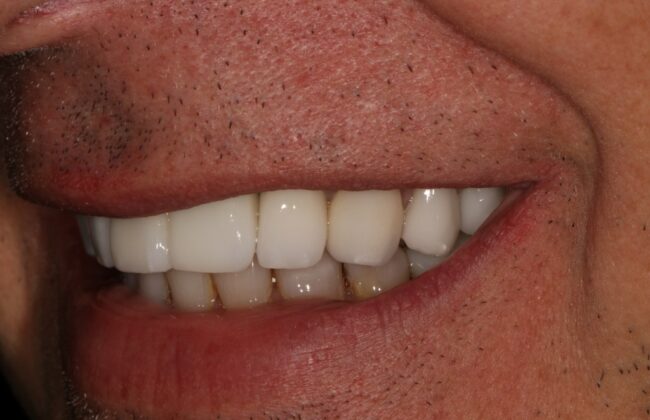 After (Teeth)
