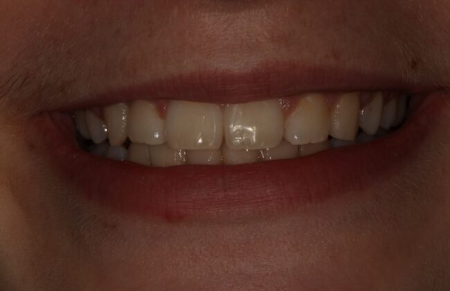 After (Teeth)