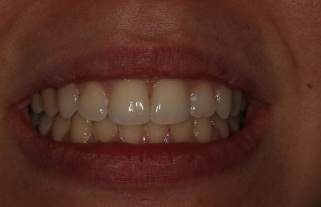 After (Teeth)