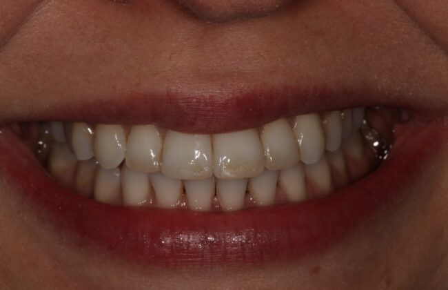 After (Teeth)