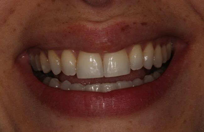 After (Teeth)