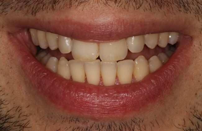 After (Teeth)