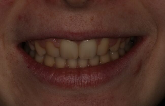 After (Teeth)