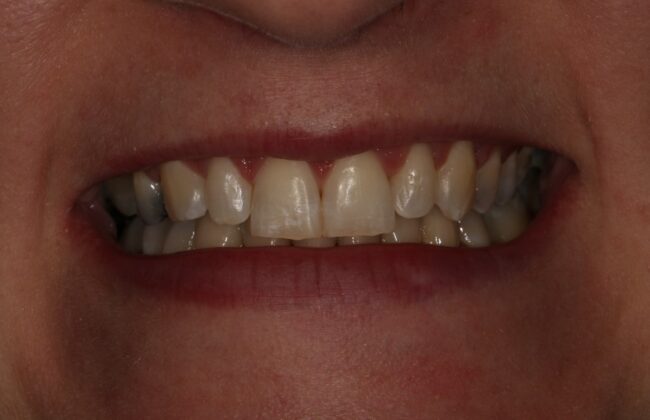 After (Teeth)
