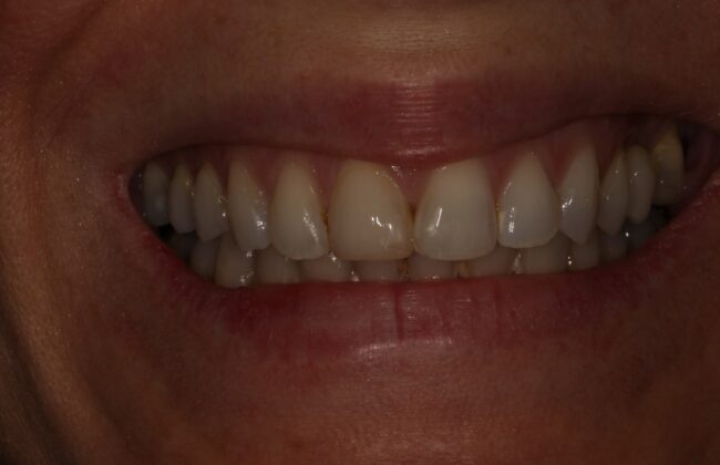 After (Teeth)