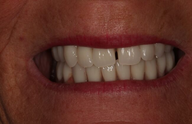 After (Teeth)