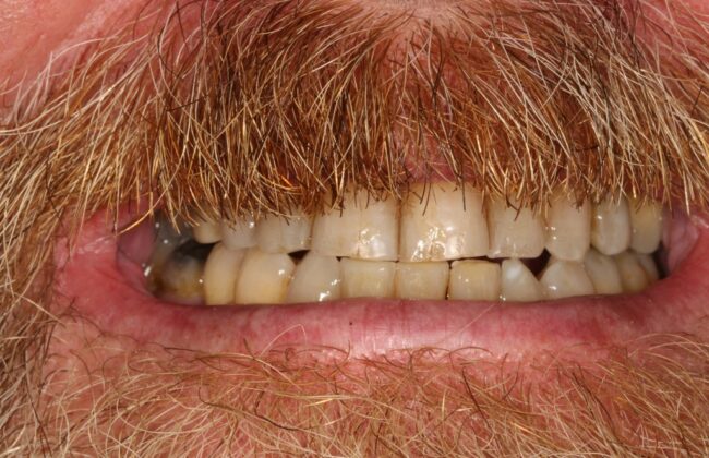 After (Teeth)