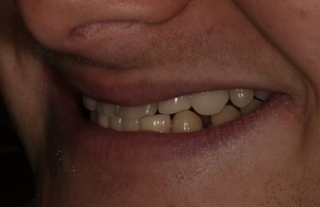 After (Teeth)
