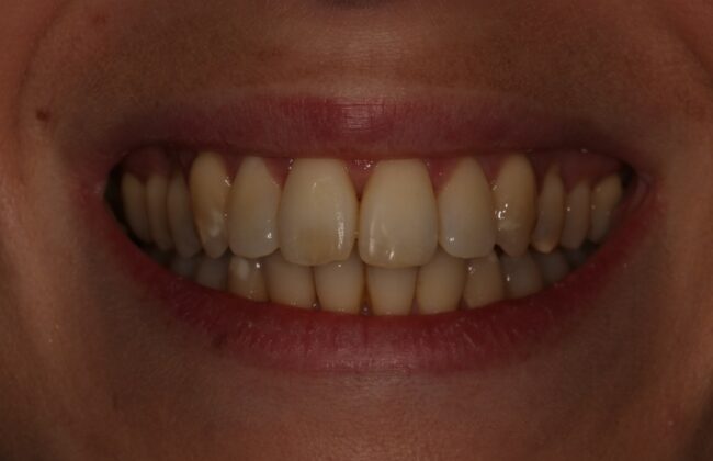 After (Teeth)