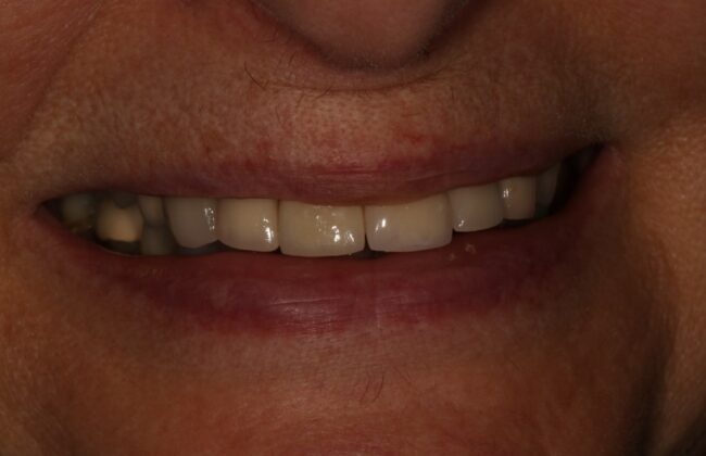 After (Teeth)