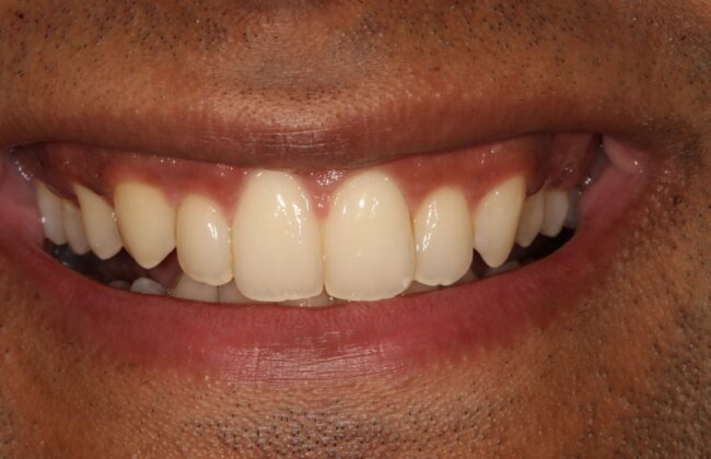 After (Teeth)