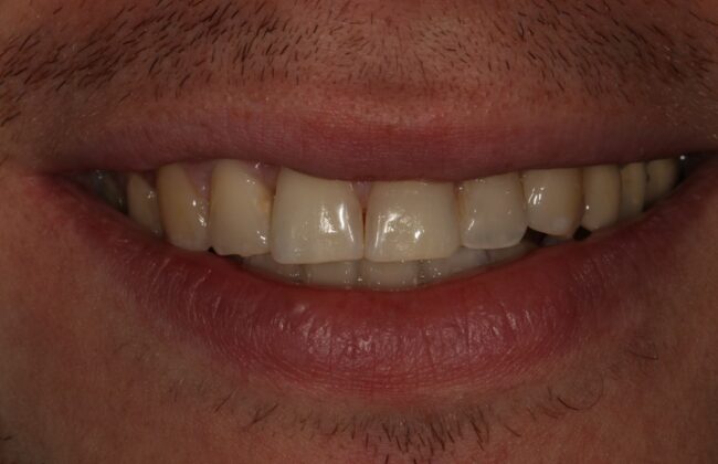 After (Teeth)