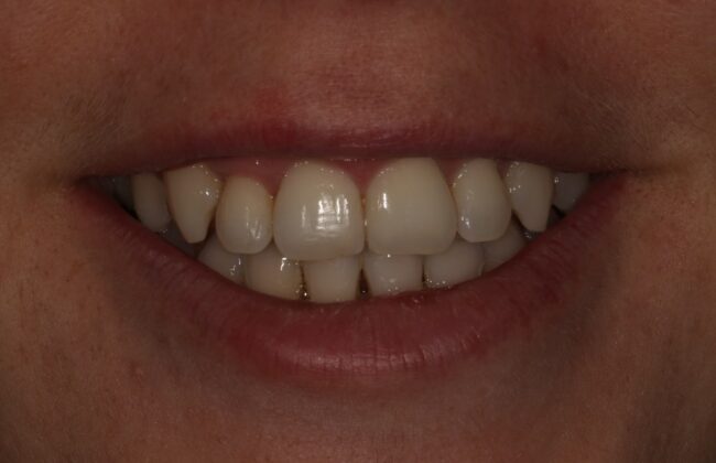 After (Teeth)