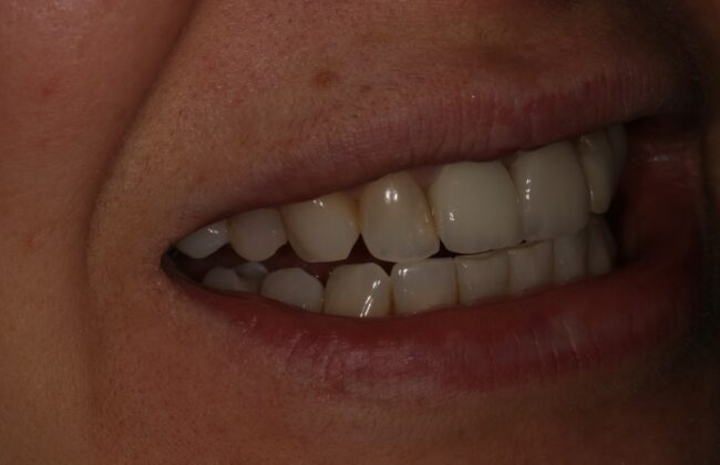 After (Teeth)