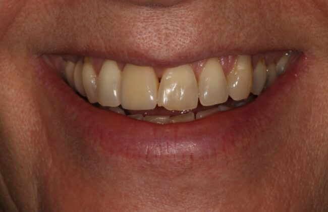 After (Teeth)