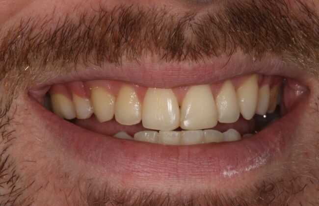 After (Teeth)
