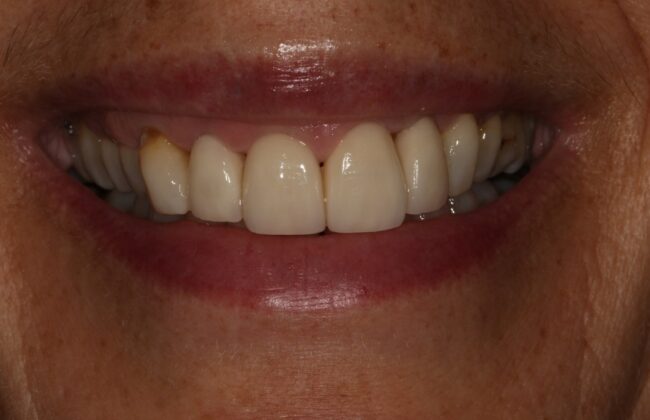 After (Teeth)