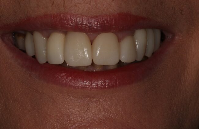 After (Teeth)