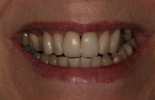 After (Teeth)