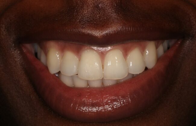 After (Teeth)