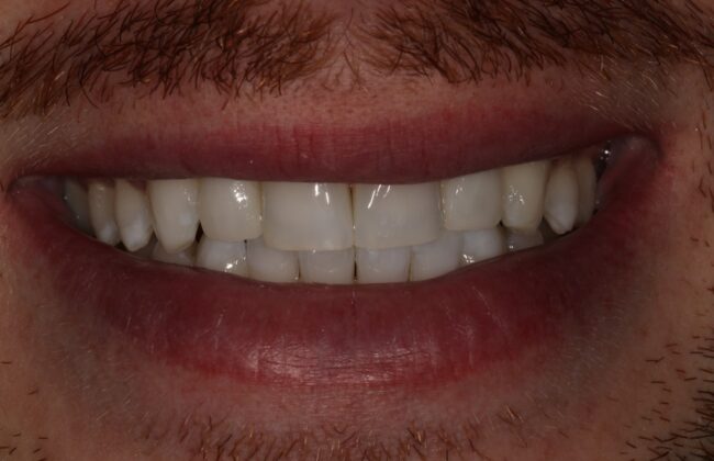 After (Teeth)