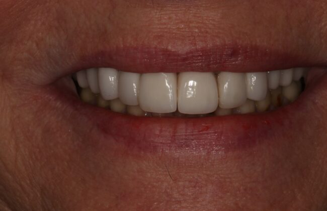 After (Teeth)