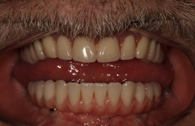 After (Teeth)