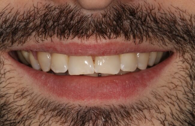 After (Teeth)