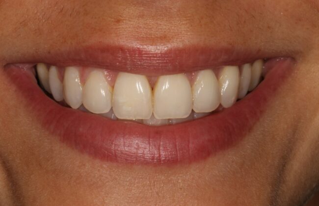 After (Teeth)