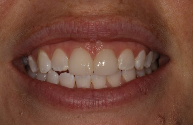 After (Teeth)