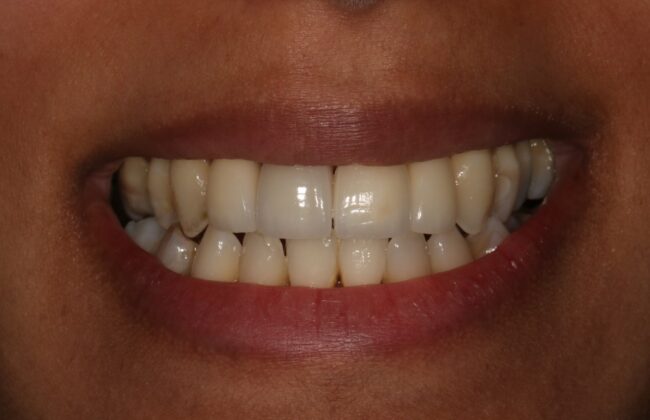 After (Teeth)