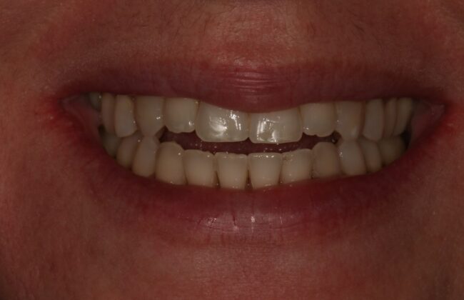 After (Teeth)