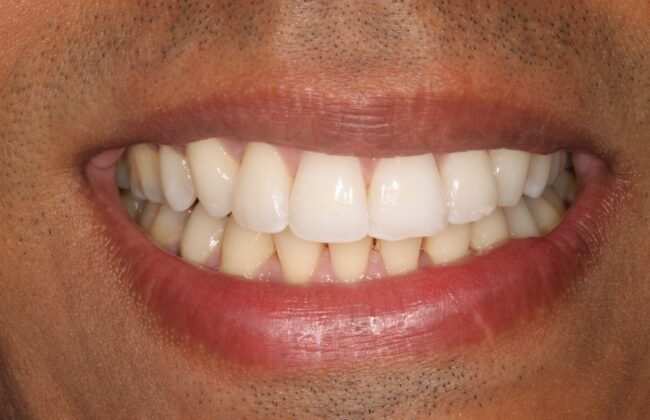 After (Teeth)
