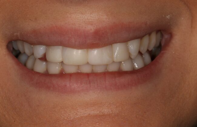 After (Teeth)