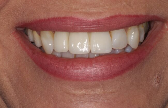 After (Teeth)
